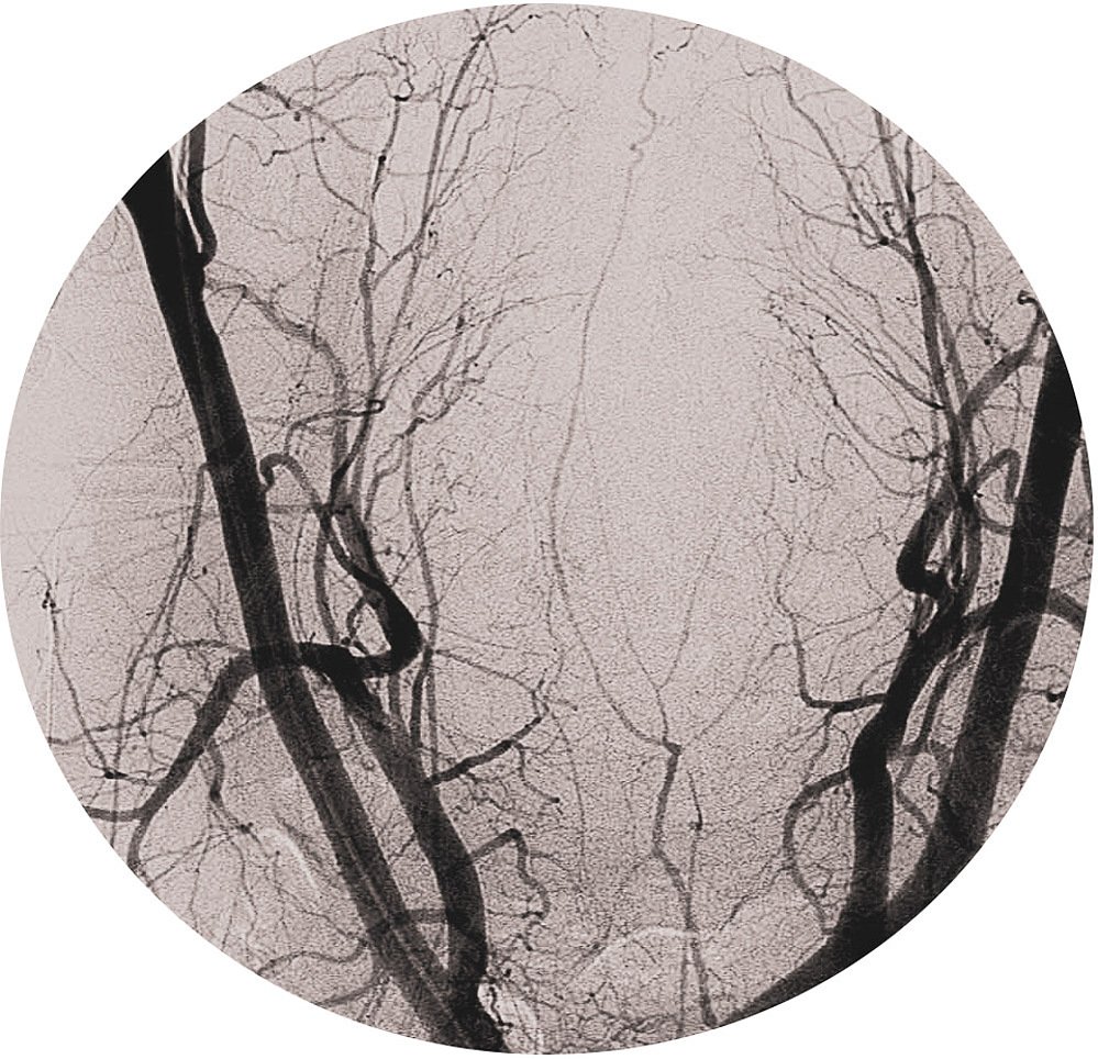 broken body I, painted angiogram, lost trees, 2022