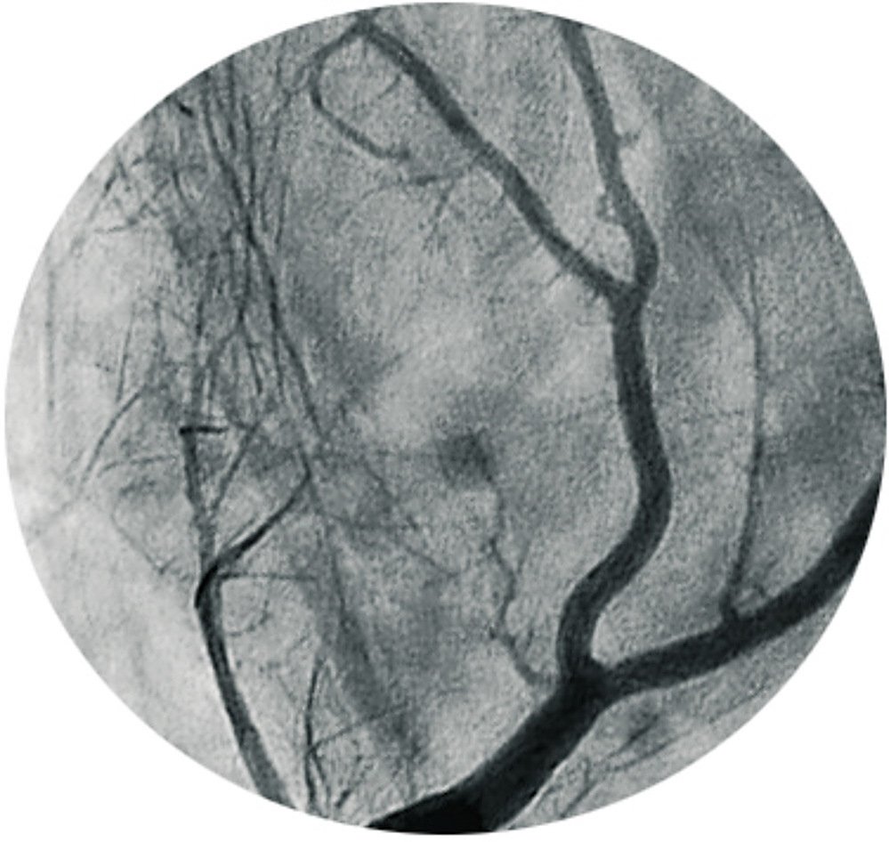 broken body II, painted angiogram, lost trees, 2022