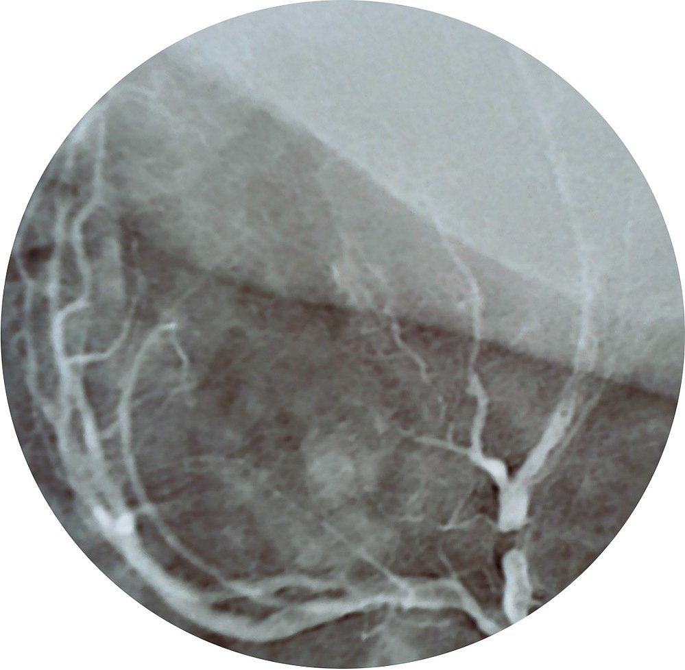 broken heart I, painted angiogram, lost trees, 2022