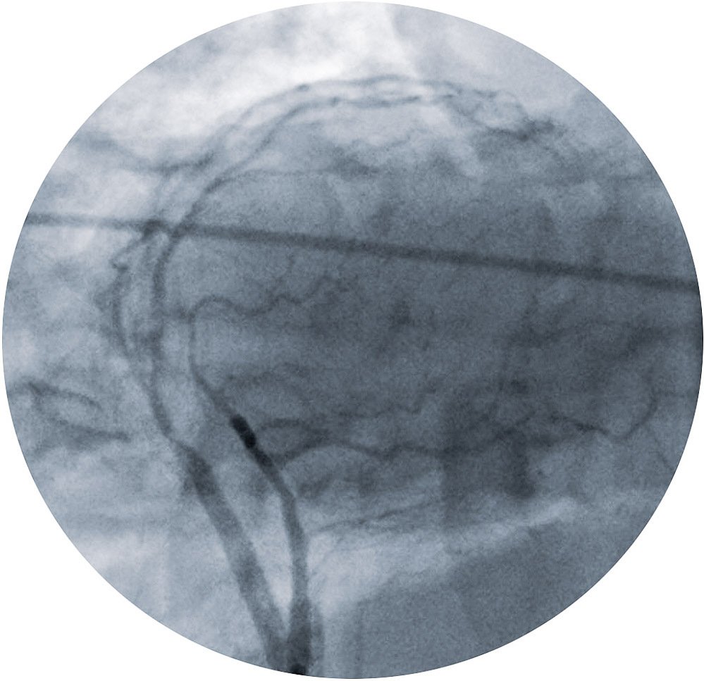 broken heart II, painted angiogram, lost trees, 2022