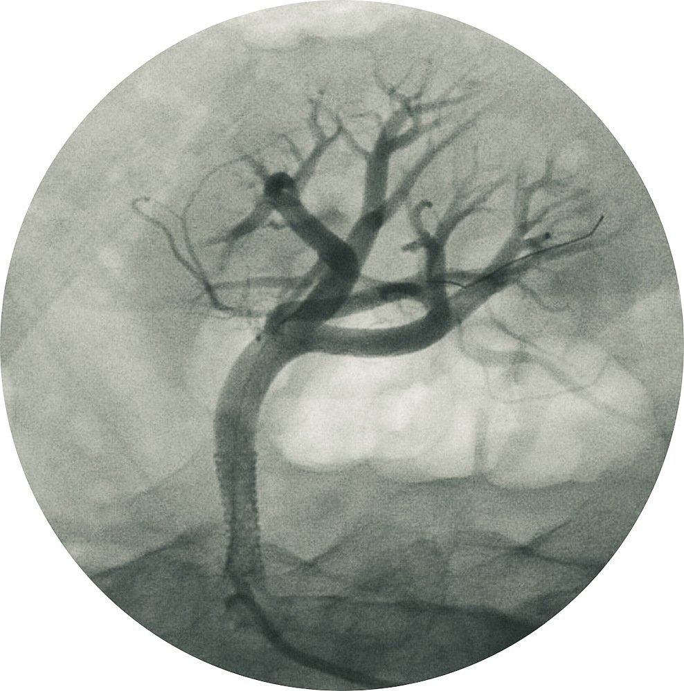 broken mind I, painted angiogram, lost trees, 2022
