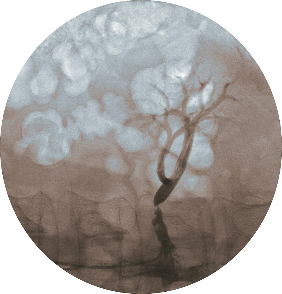 broken mind II, painted angiogram, lost trees, 2022