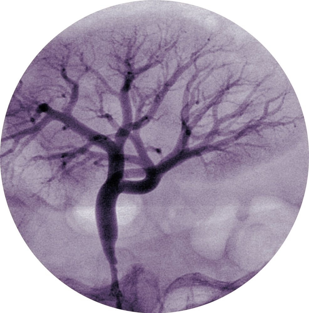 broken spirit I, painted angiogram, lost trees, 2022