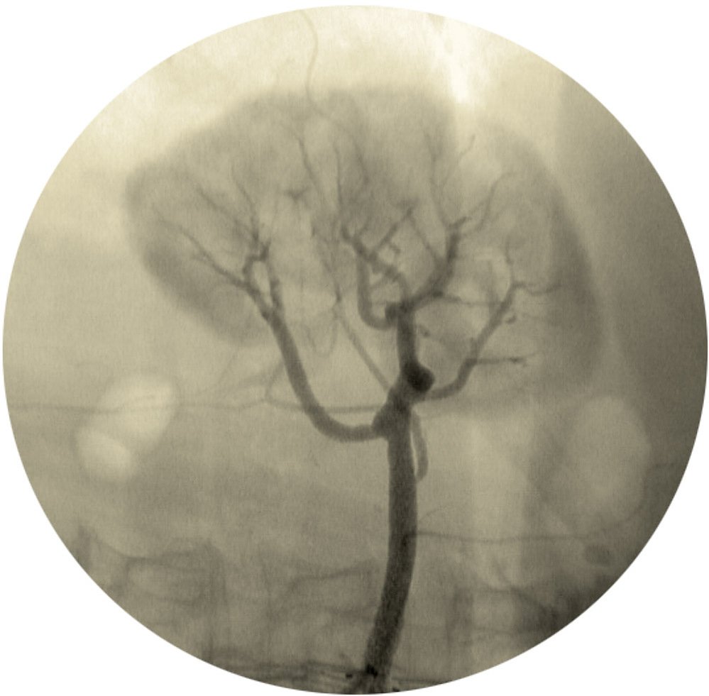 broken spirit II, painted angiogram, lost trees, 2022